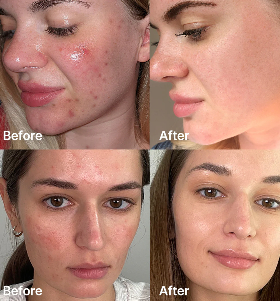 Serum Red Succinic Acid - Para Piel Con Granos, Manchas Noche - Image 2